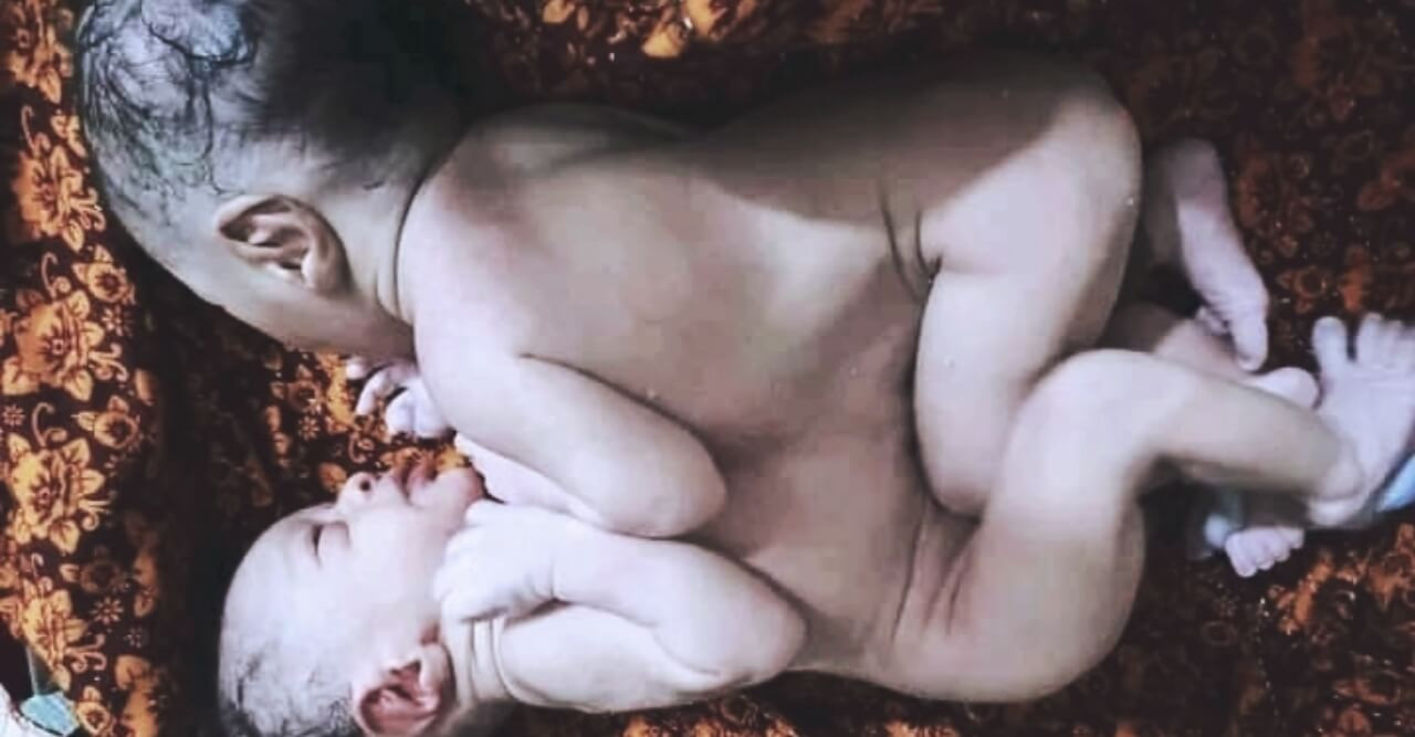 ভোলার লালমোহনে জন্ম নিয়েছে জোড়া লাগানো জমজ শিশু